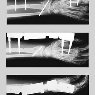 Arm with External Fixation