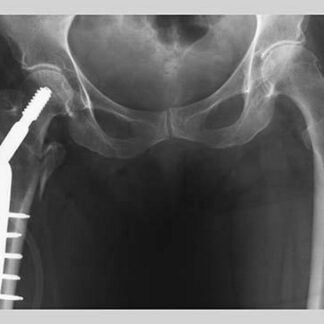 Femur Repair