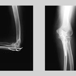 Shattered Elbow Repair